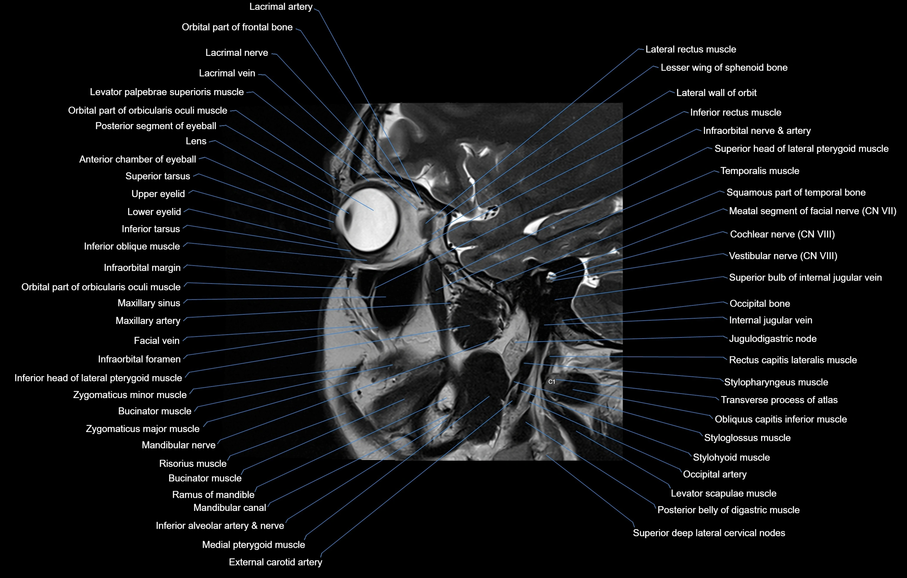 paranasal sinuses(PNS) MRI coronal  cross sectional anatomy 3T radiology  image-img-00001-00014.webp